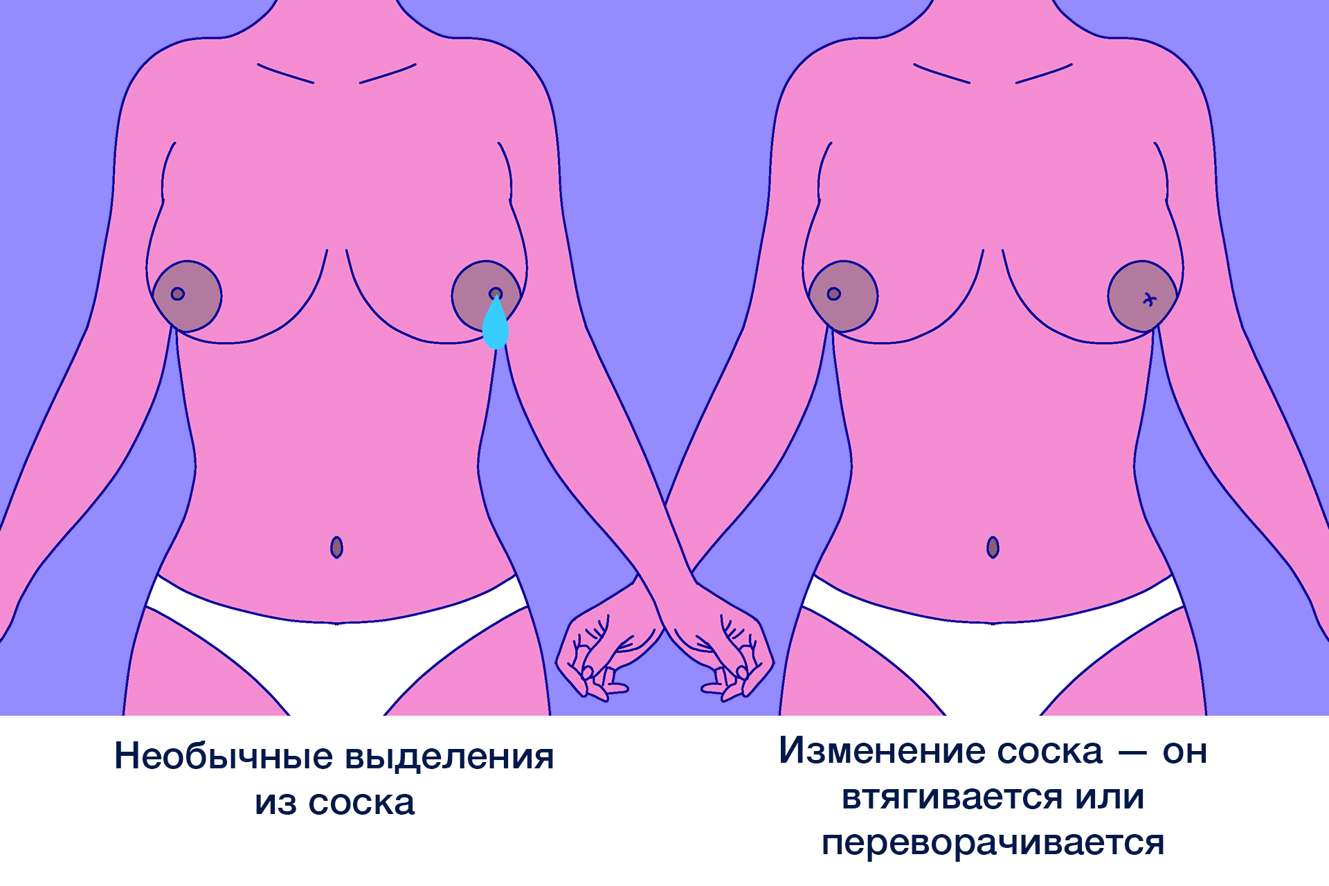 выделение из груди у женщин в чем причина фото 94