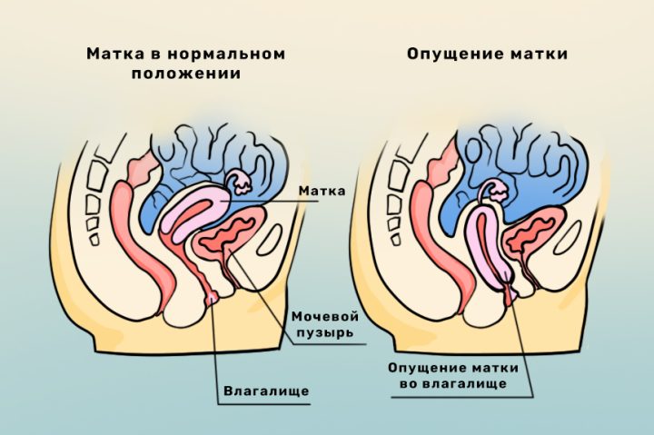 Выпадение и опущение органов малого таза