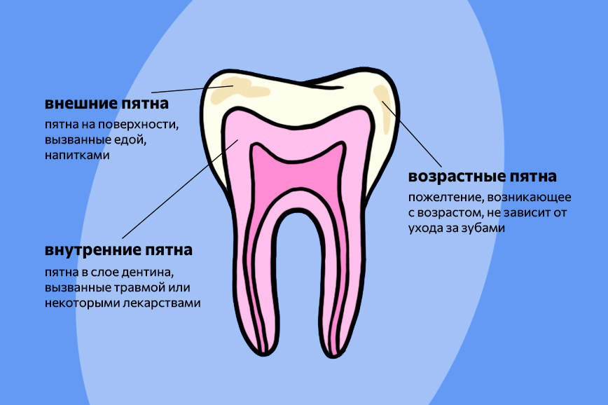 Почему зубы меняют цвет