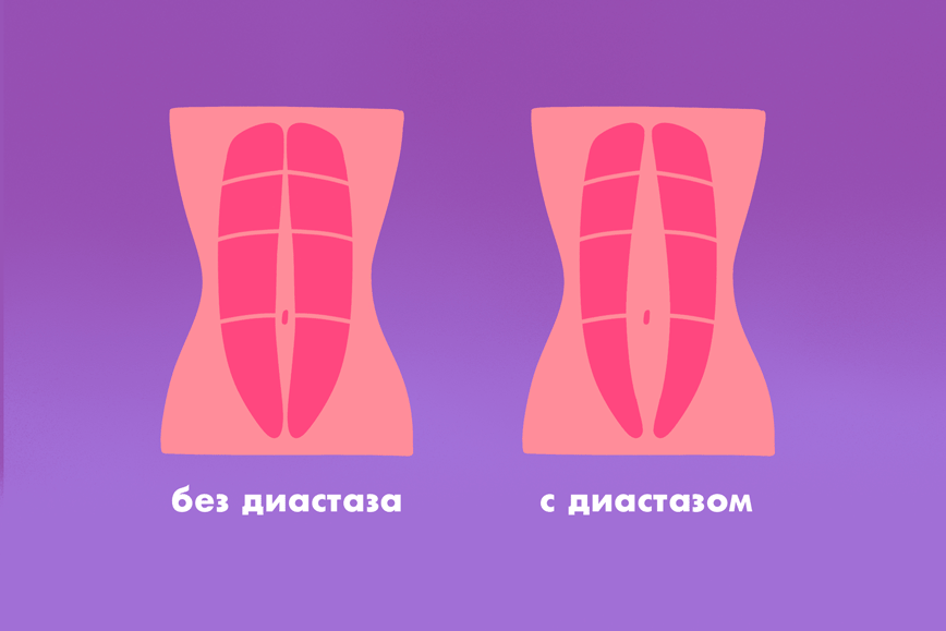 Тянущие боли внизу живота могут возникать и на ранних сроках беременности | Pro-беременность | Дзен